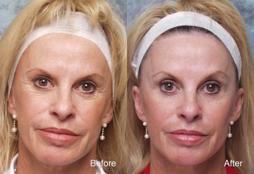 Feel the Change after Botox Treatment by Lesley Reynolds