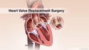 Heart Valve Replacement Surgery as a Heart Treatment Surgery by Health Geek